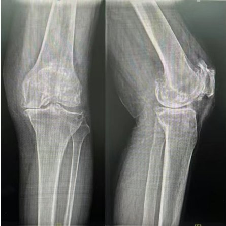 Heart Bypass Surgery